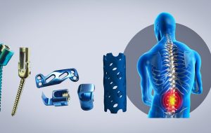 استفاده از فناوری نانو در ایمپلنت‌های پیوند ستون فقرات