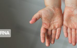 ابتلای هزار نفر به سرخک/بیشتر مبتلایان اتباع خارجی هستند