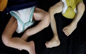 مسئول بیمارستان ناصر در غزه: جان هزاران کودک این باریکه در خطر است